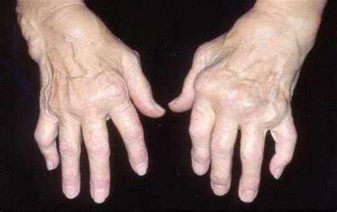 как да се облекчи възпалението на ставите на пръстите